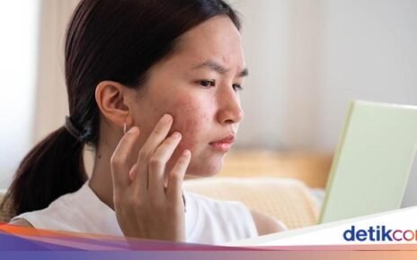 Jerawat Sering Muncul? Atasi dengan 6 Makanan Pembasmi Jerawat Ini