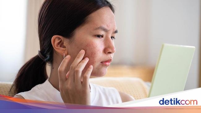 Jerawat Sering Muncul? Atasi dengan 6 Makanan Pembasmi Jerawat Ini