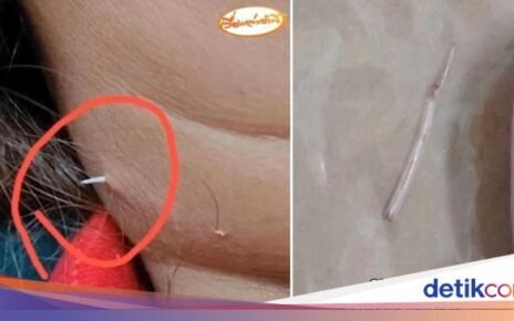 10 Benda Nyangkut di Tenggorokan hingga Tertelan, Ada Sikat Gigi di Lambung!