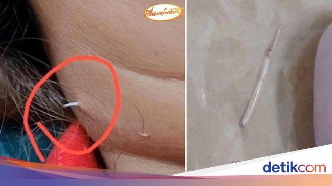 10 Benda Nyangkut di Tenggorokan hingga Tertelan, Ada Sikat Gigi di Lambung!