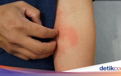 Hindari 6 Makanan yang Picu Alergi Kulit dan Bikin Makin Parah