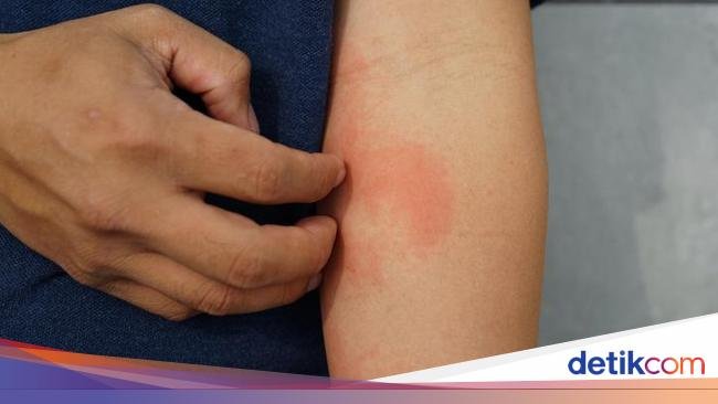 Hindari 6 Makanan yang Picu Alergi Kulit dan Bikin Makin Parah