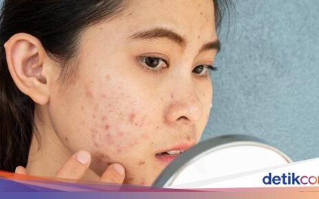 Batasi Konsumsinya! 7 Makanan Pemicu Jerawat Parah pada Orang Dewasa