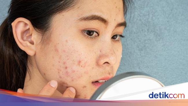 Batasi Konsumsinya! 7 Makanan Pemicu Jerawat Parah pada Orang Dewasa