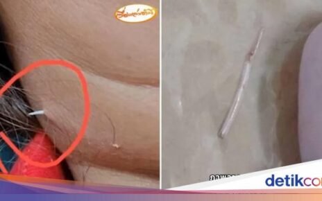 Wanita Ini Tersedak Duri Ikan Sampai Menembus Kulit Lehernya