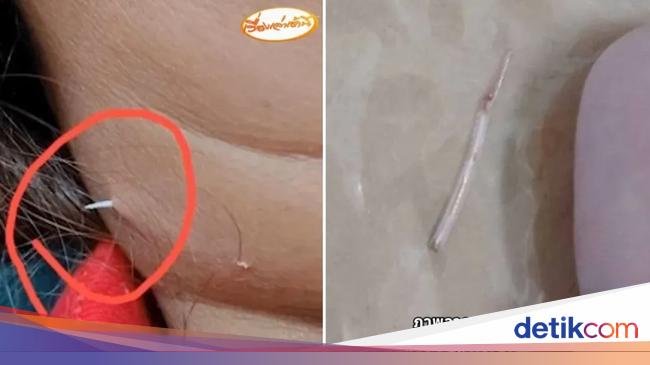 Wanita Ini Tersedak Duri Ikan Sampai Menembus Kulit Lehernya