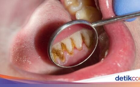 Ew! 7 Makanan dan Minuman Ini Bikin Karang Gigi Cepat Numpuk