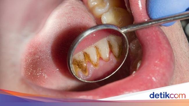 Ew! 7 Makanan dan Minuman Ini Bikin Karang Gigi Cepat Numpuk