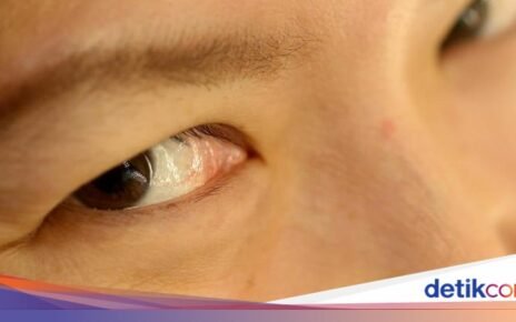 Area Mata Mulai Keriput? Ini 7 Makanan untuk Cegah Penuaan Dini!