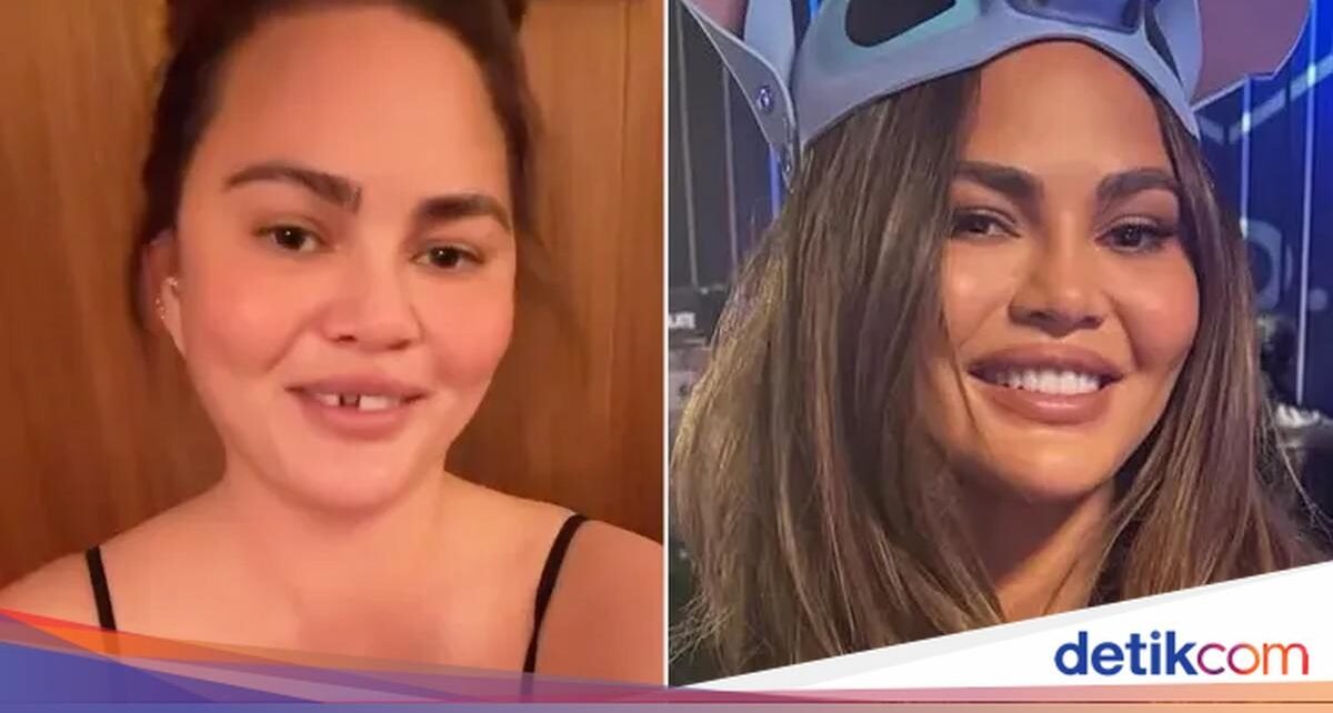 Waduh! Gigi Chrissy Teigen Copot Usai Gigit Permen Tongkat